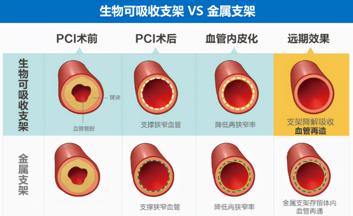 降解支架国内最新进展概览