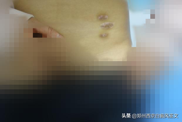 最新白斑治疗方法，助你重拾肌肤光彩！