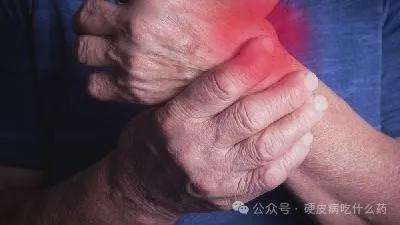 硬皮病最新治疗进展与论述