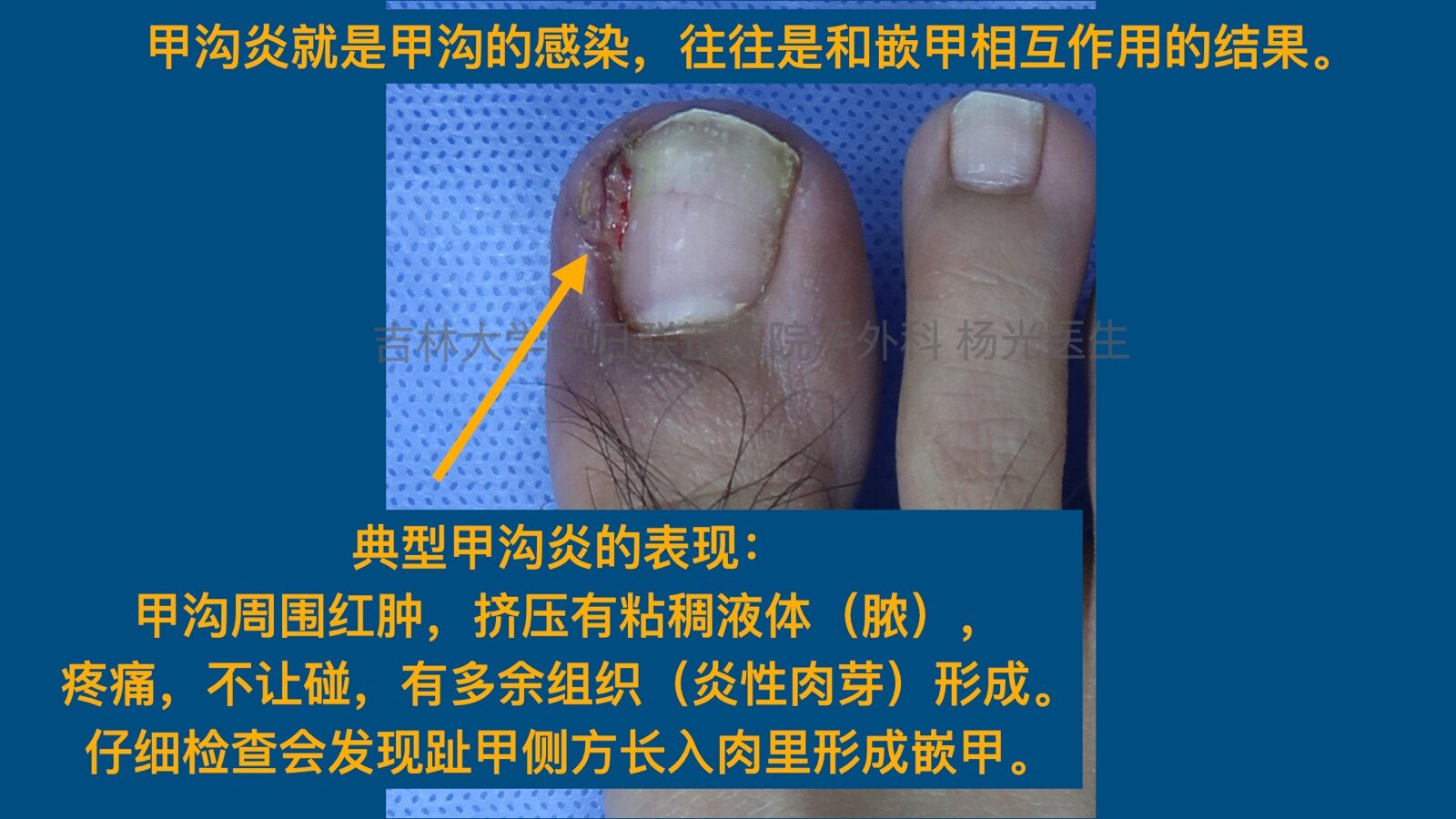 探索甲沟炎治愈之旅，小巷特色小店最新治疗视频分享