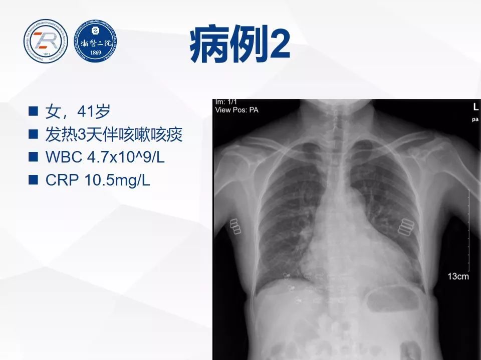 最新肺炎真实情况解析，了解、防范与应对策略